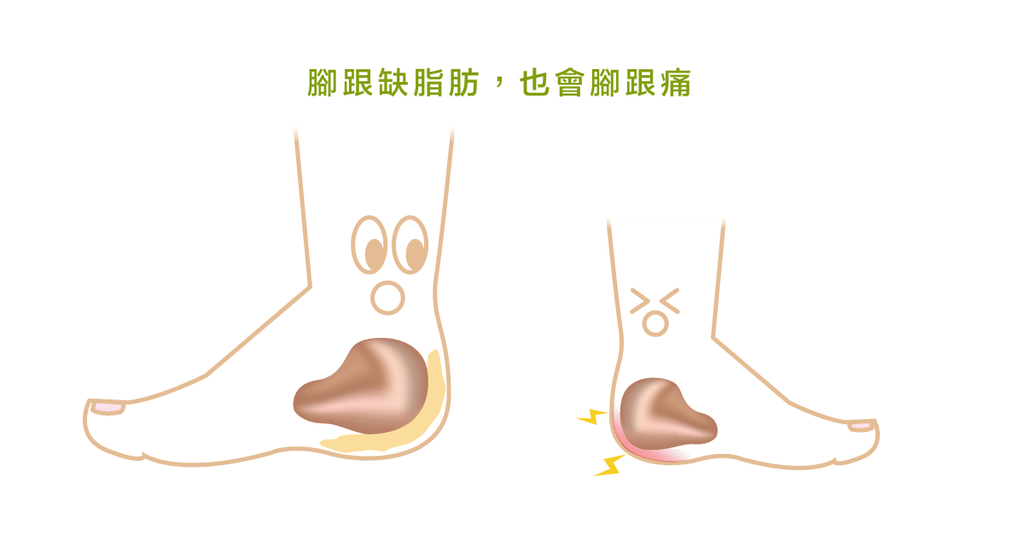 足跟痛不一定是足底筋膜炎!物理治療師分享4種常見的足跟疼痛問題 - Bestmade 人學院
