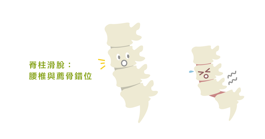 脊椎滑脫的起因、症狀是什麼?和椎間盤突出的差異在哪? - Bestmade 人學院