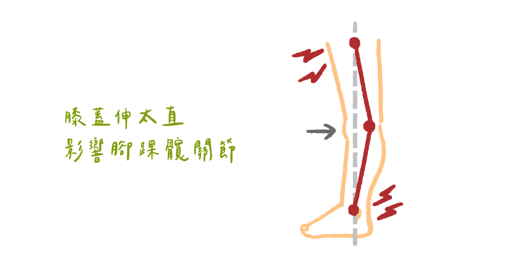 站立時膝蓋往後彎?物理治療師:膝關節過度伸直對身體的傷害(上) - Bestmade 人學院