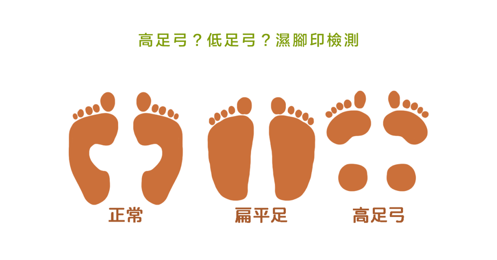 扁平足潛在病症多!骨科醫生:扁平足的檢測與矯正運動(下) - Bestmade 人學院