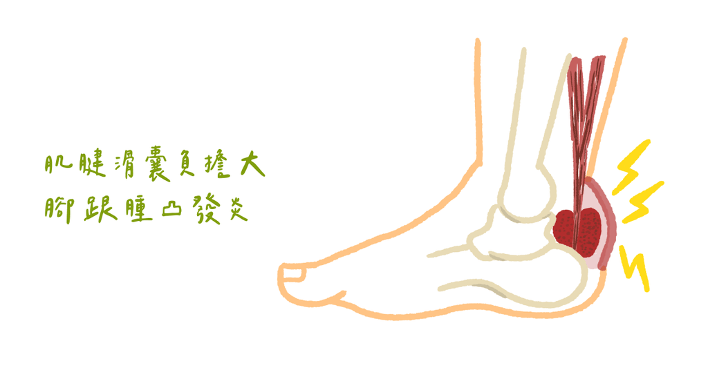 腳跟又腫又凸?物理治療師:認識哈格倫氏症候群 - Bestmade 人學院