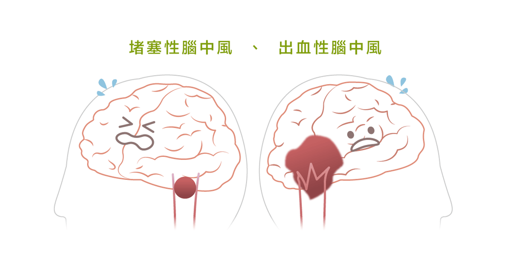 中風後積極復健,早期回復生活自主 - Bestmade 人學院