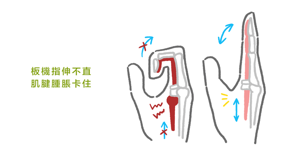 手指頭疼痛伸不直?骨科醫師帶你認識:什麼是板機指(上) - Bestmade 人學院