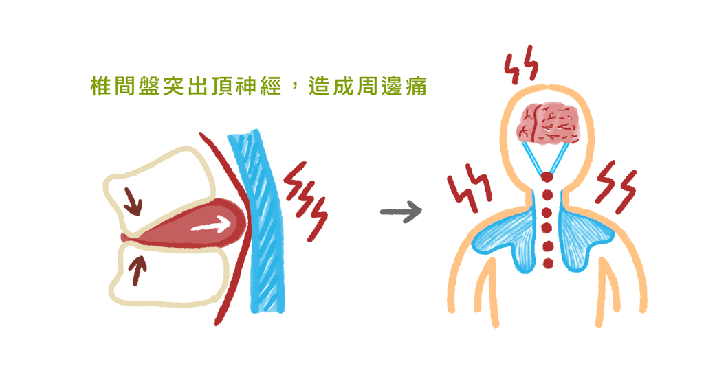 肩頸痠痛、膏肓痛、手臂痛?物理治療師:可能是椎間盤突出 - Bestmade 人學院