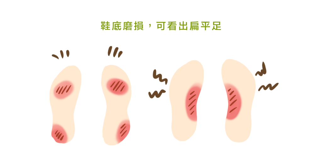 從鞋底看足弓健不健康!骨科醫師告訴你:真的需要訂做鞋墊嗎? - Bestmade 人學院