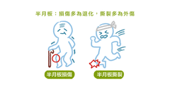 半月板損傷跟半月板撕裂不一樣?物理治療師帶你認識「半月板傷害」