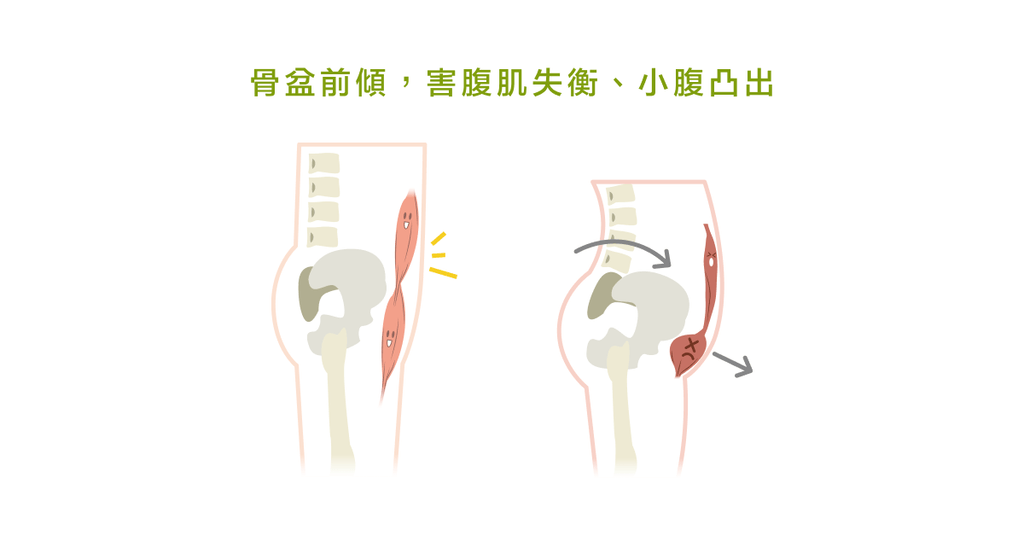 引以為傲的翹臀,其實只是「骨盆前傾問題」! - Bestmade 人學院