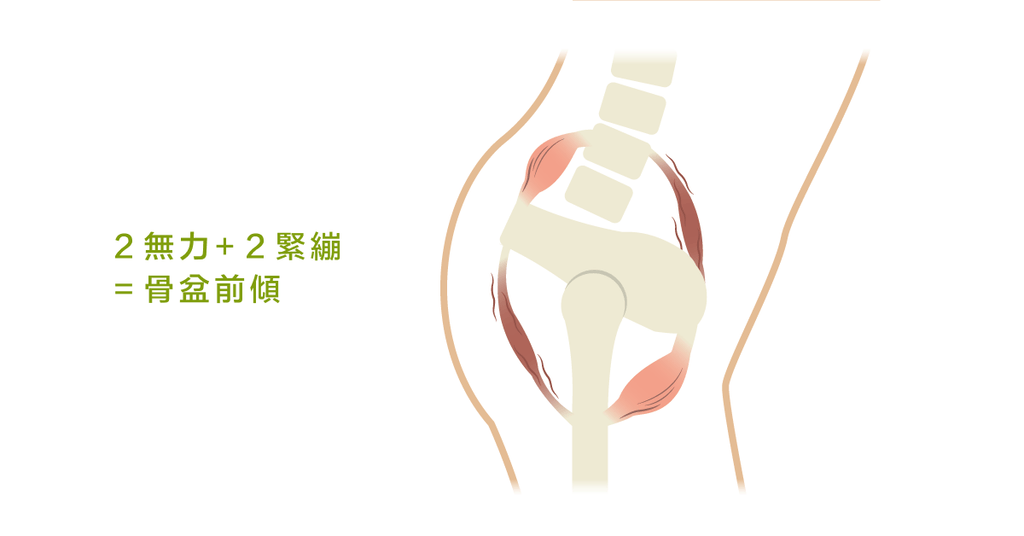 十個翹臀九個病:被遺忘的骨盆前傾 - Bestmade 人學院