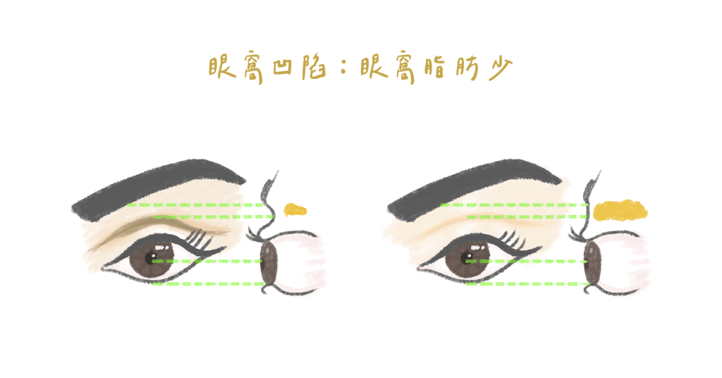 眼窩凹陷,可以填補脂肪嗎? - Bestmade 人學院