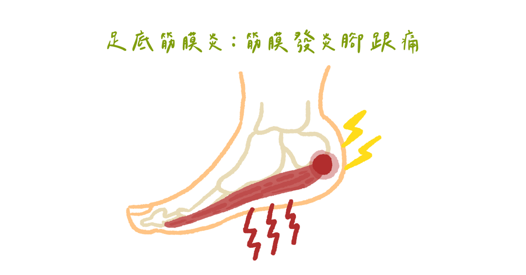 起床腳著地像踩到釘子?復健科醫師:弓箭步拉腳筋,避免足底筋膜炎 - Bestmade 人學院