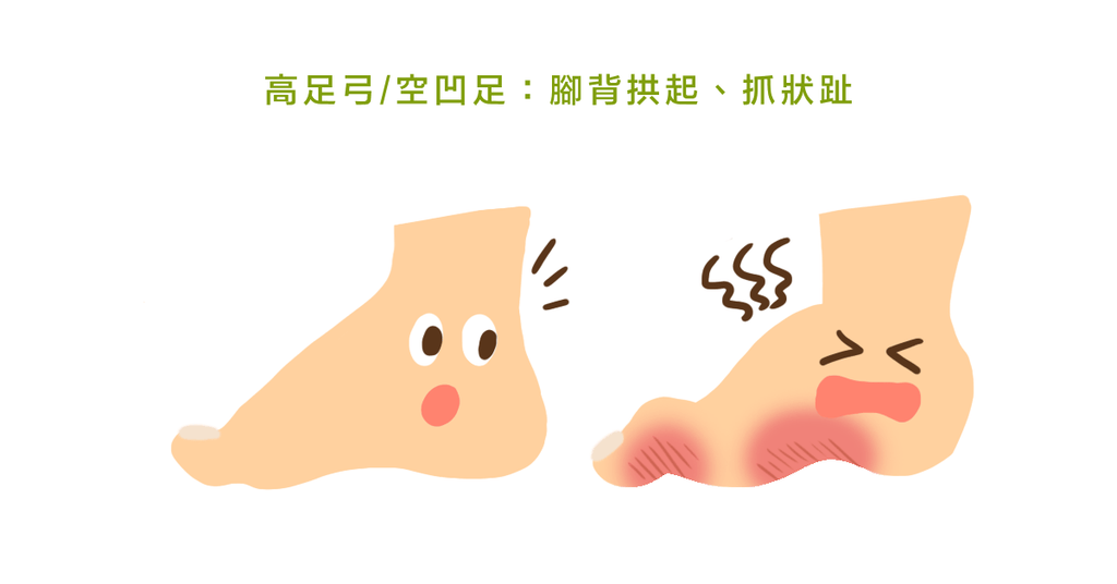 扁平足不稀奇,聽過高足弓嗎?骨科醫師:高足弓的舒緩與運動 - Bestmade 人學院