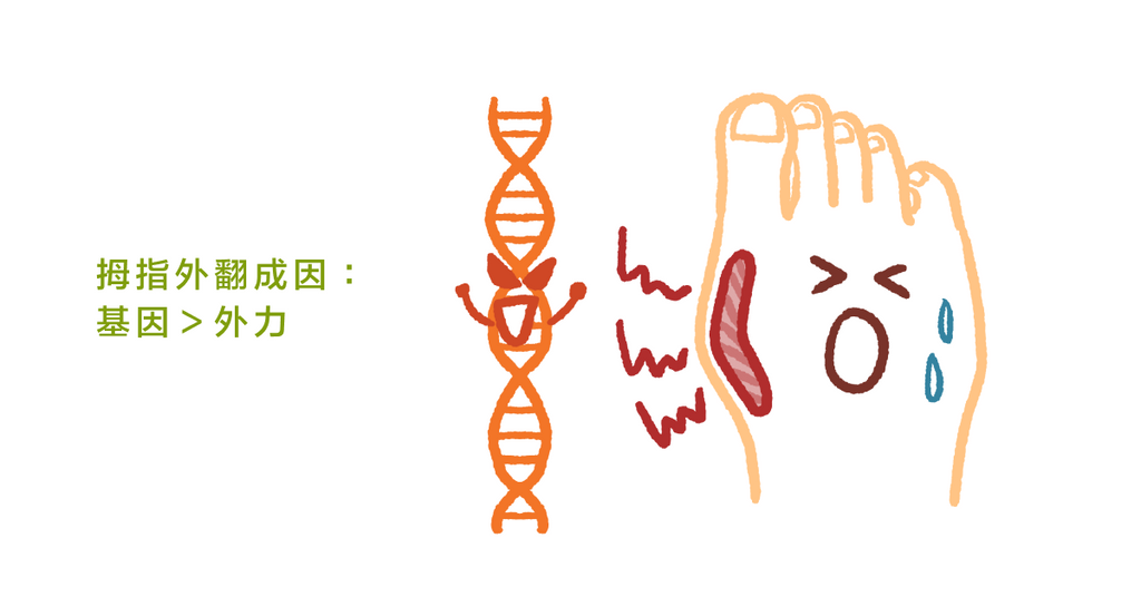 穿尖頭鞋造成拇指外翻？研究指出拇指外翻基因才是主要原因