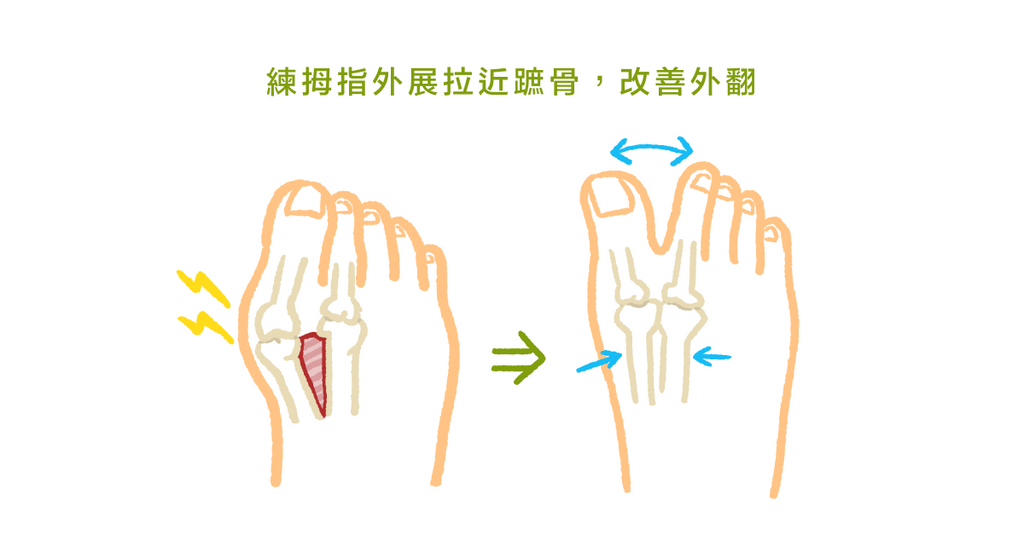 拇趾外翻一定要開刀嗎？物理治療師：改善拇指外翻的運動