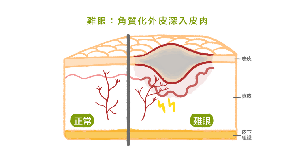 長在腳上惱人的雞眼，反覆好發怎麼辦？