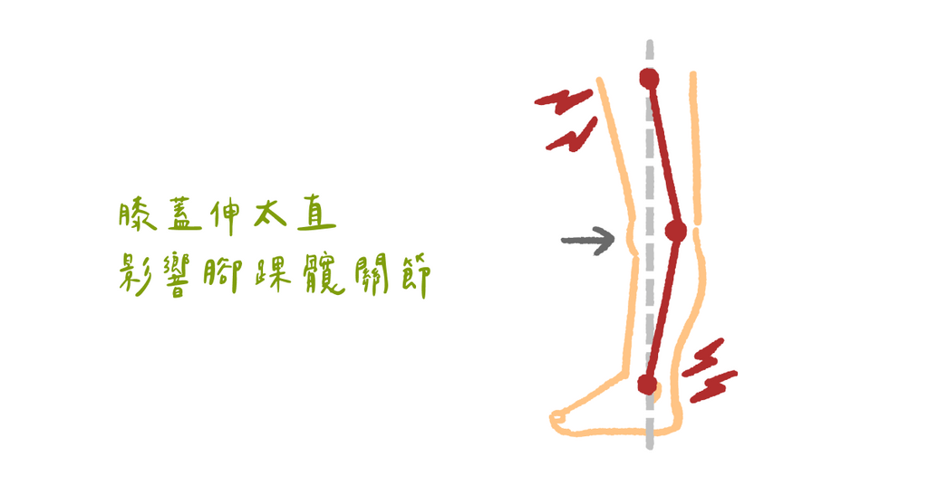 站立時膝蓋往後彎？物理治療師：膝關節過度伸直對身體的傷害（上）