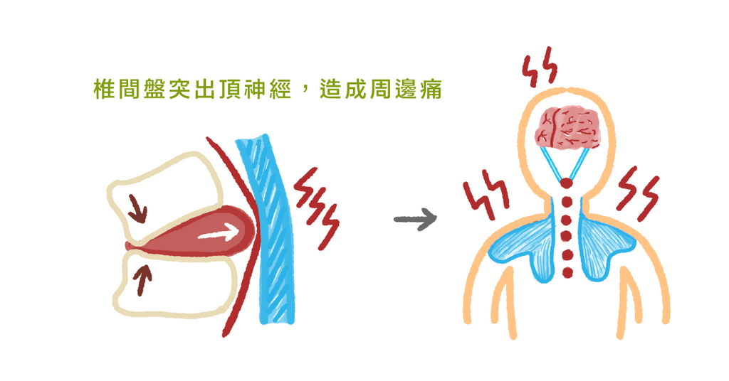 肩頸痠痛、膏肓痛、手臂痛？物理治療師：可能是椎間盤突出