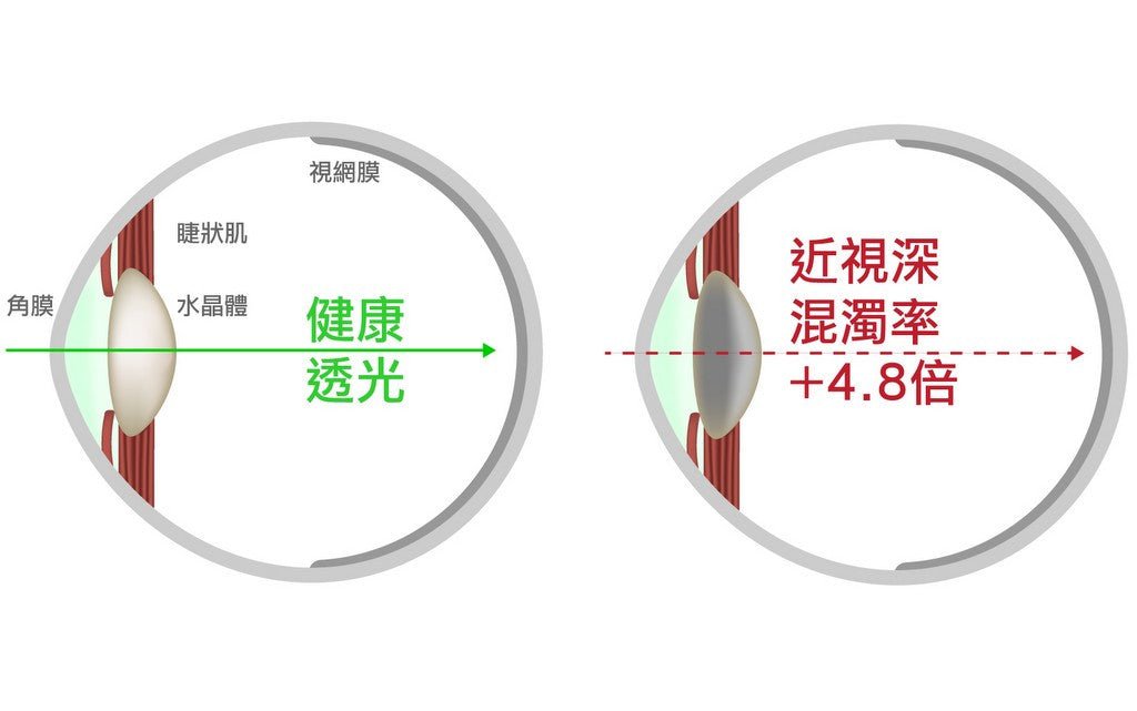 近視深，有白內障的機率高了快5倍 - Bestmade 人學院