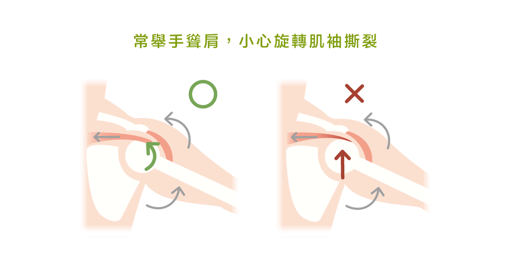 肩膀不舒服？可能跟旋轉肌袖撕裂有關！ - Bestmade 人學院