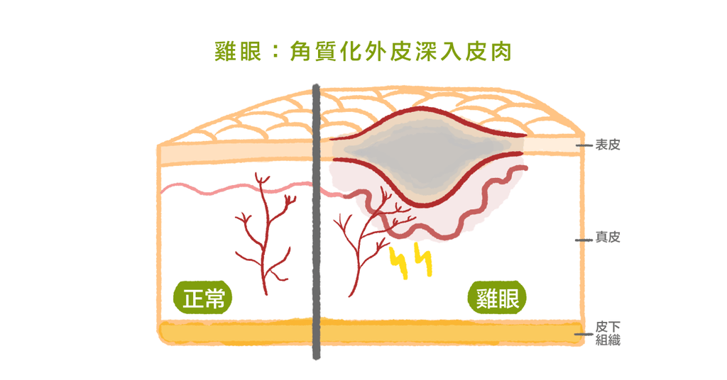 長在腳上惱人的雞眼，反覆好發怎麼辦？ - Bestmade 人學院