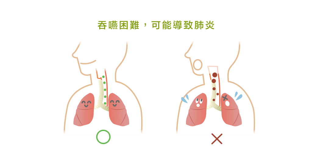 吞嚥困難如何復健治療 - Bestmade 人學院