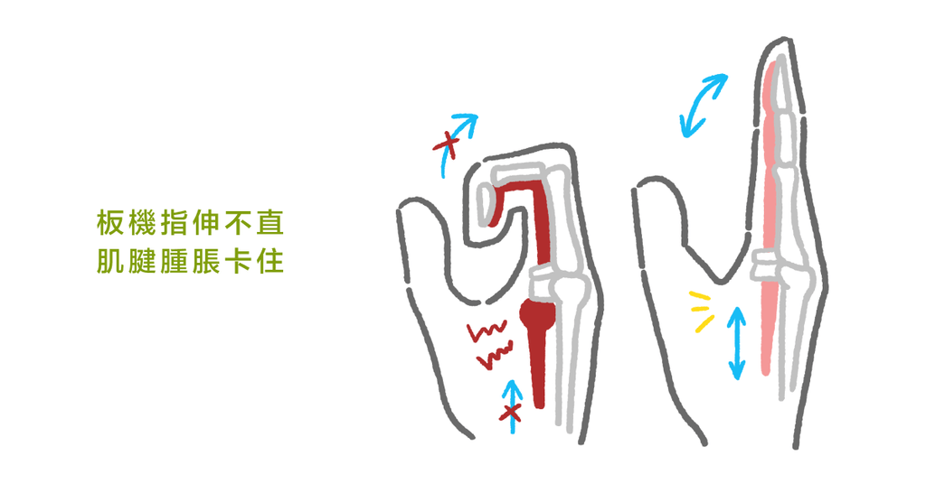 手指頭疼痛伸不直？骨科醫師帶你認識：什麼是板機指（上） - Bestmade 人學院