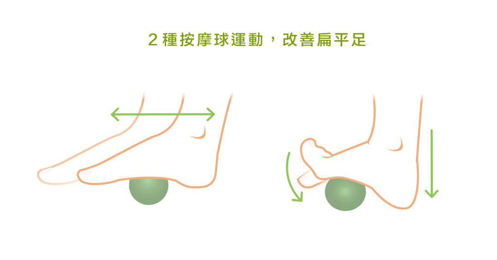 扁平足是可以治療的嗎？ - Bestmade 人學院