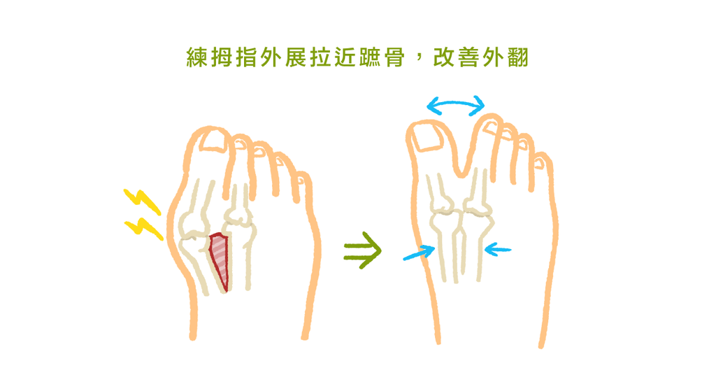 拇趾外翻一定要開刀嗎？物理治療師：改善拇指外翻的運動 - Bestmade 人學院