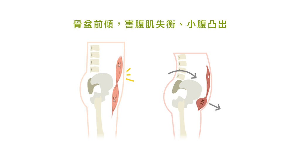 引以為傲的翹臀，其實只是「骨盆前傾問題」！ - Bestmade 人學院