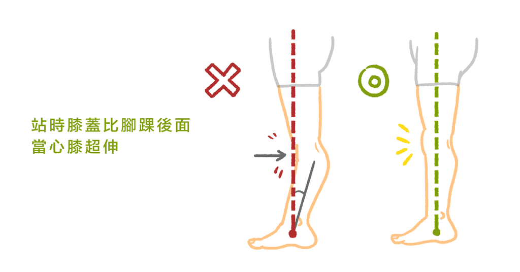 身體不出力讓膝蓋過度往後推，小心膝超伸找上門 - Bestmade 人學院