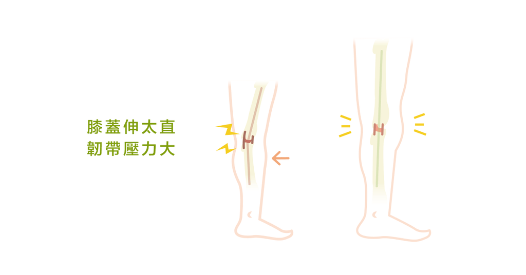 走路姿勢怪怪的？何謂「膝過度伸直」？ - Bestmade 人學院